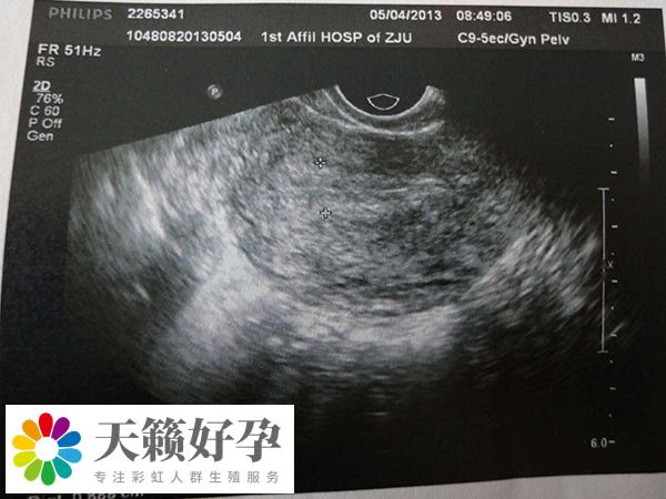 人授失败转试管要注意调整子宫环境