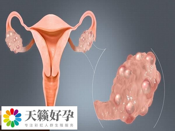 输卵管存在炎症大部分会有积水