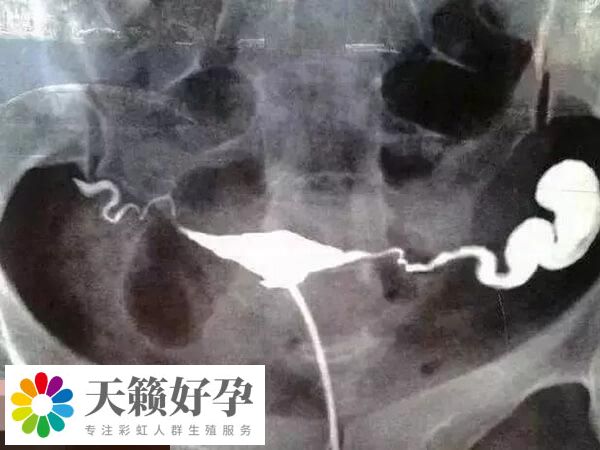 输卵管积水含微生物碎屑等有害物质多