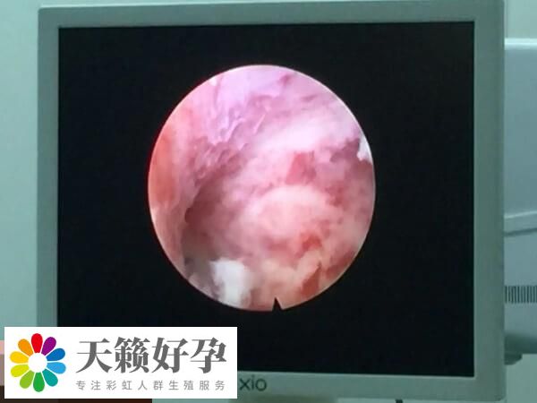 宫腔镜可以确诊宫腔疾病
