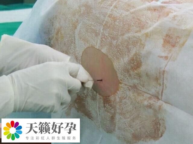 宫腔镜是一种微创性妇科诊疗技术