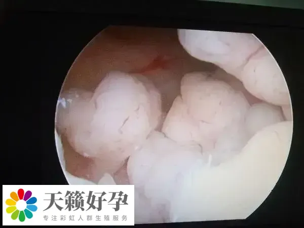 探宫最佳时期在月经干净后的3-7天