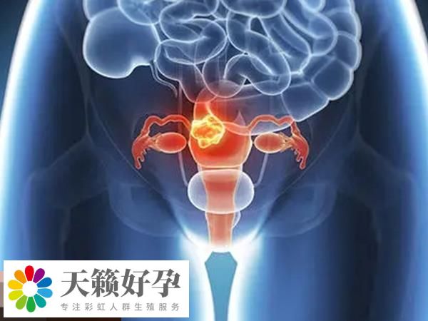 不当使用贺美奇会导致卵巢过度刺激